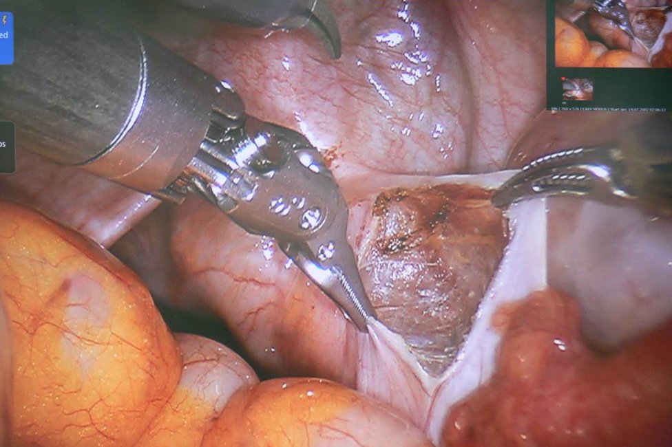 Endometriosezentrum/Meduni Wien Bild v. OP mit DaVinci-Roboter