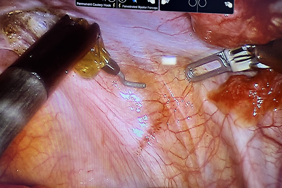 Endometriosezentrum/Meduni Wien Bild v. Hypogastrischem Nerv rechts